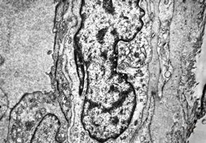 F,6m. | capillary hemangioma - hard palate